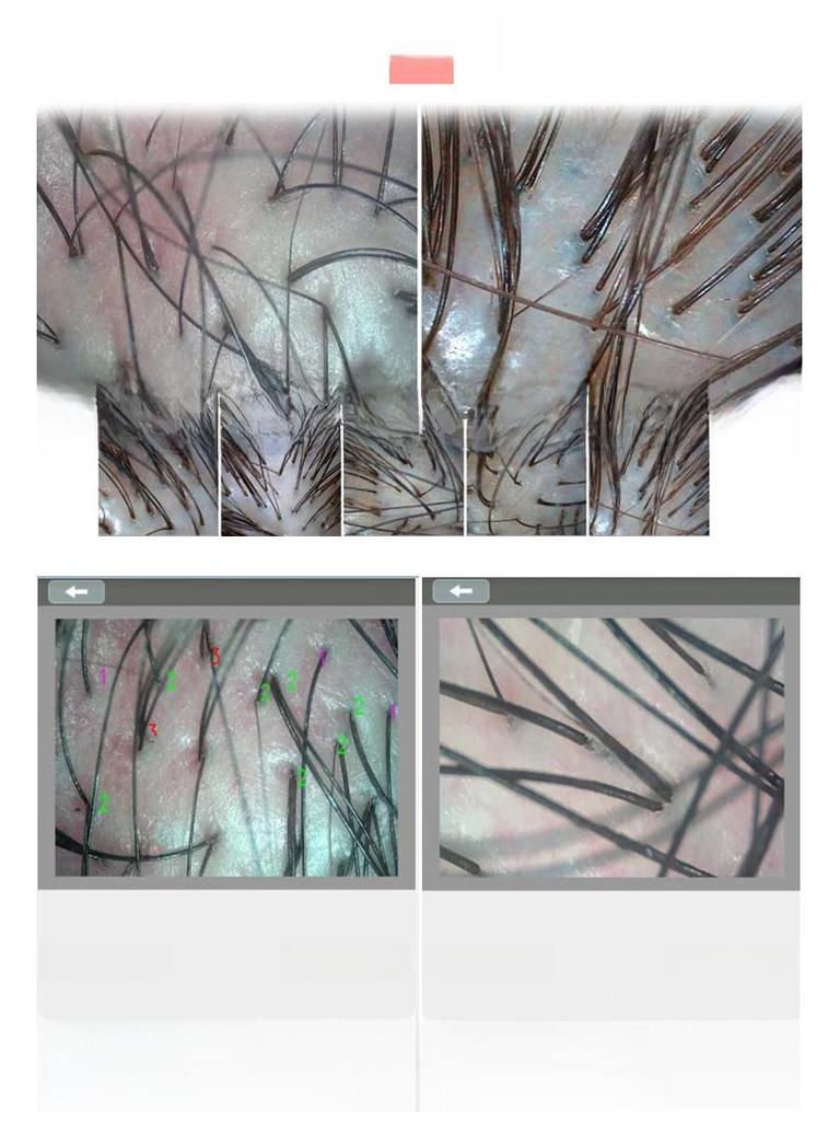 Портативный УФ-анализатор кожи и кожи головы с функцией обнаружения волос и фолликулов