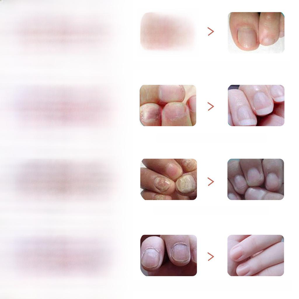 Премиальное средство для восстановления ногтей на ногах 5 мл Для обесцвеченных ногтей и смягчения ногтей