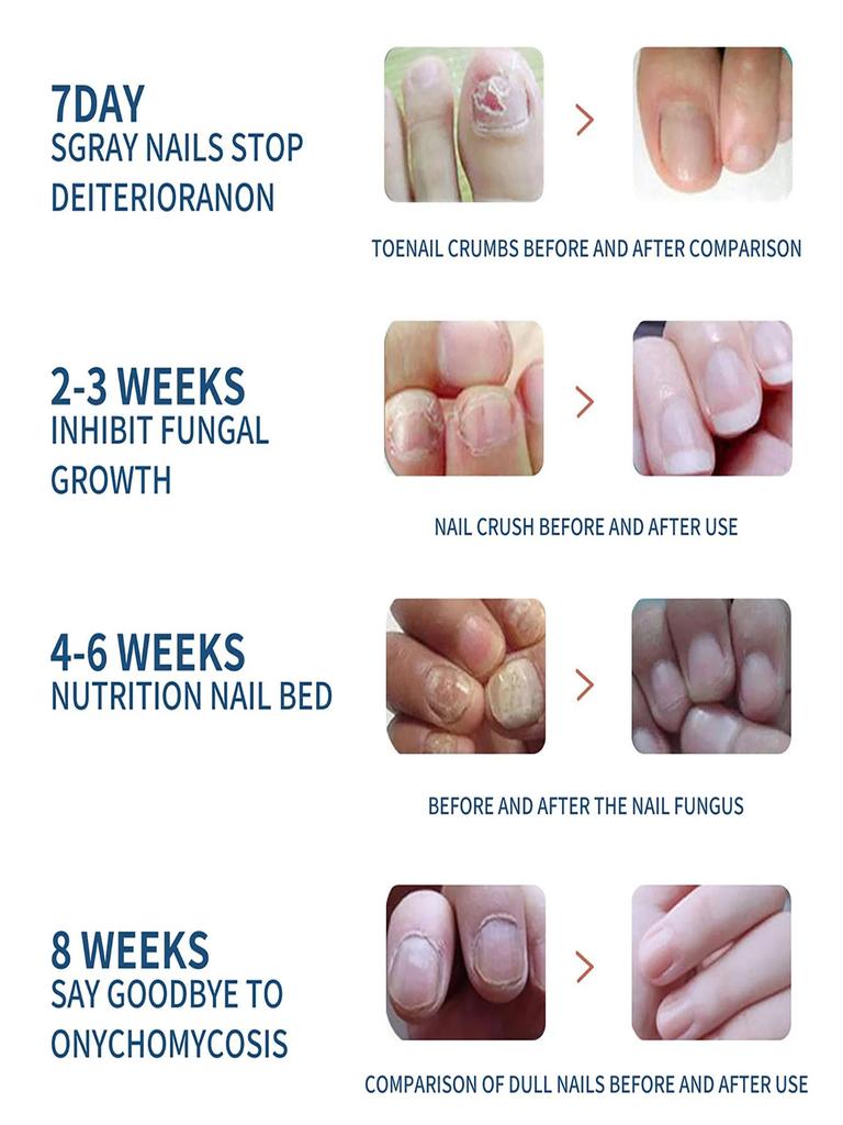 Repair Nail Fungus Treatments Essence Foot Care Serum Toe Nails Fungal Removal Gel Anti-Infection