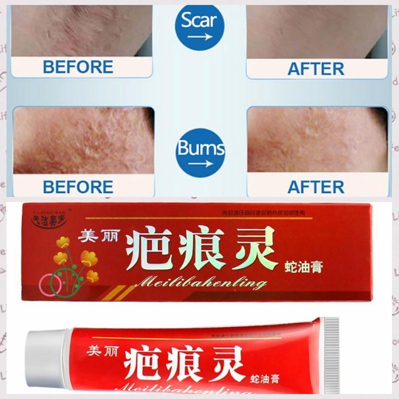 Пластырь Натуральное Змеиное Масло Крем для восстановления шрамов от прыщей Шрам Духовой ремонт Шрам от ожогов Растягивающийся анти-лавандовый