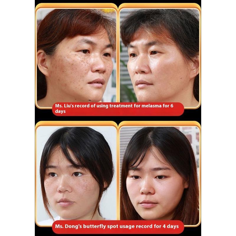 Whitening and Freckle Removing Cream Face Cream Lightening and Removing Spotles Sunburn Brightening Skin Color