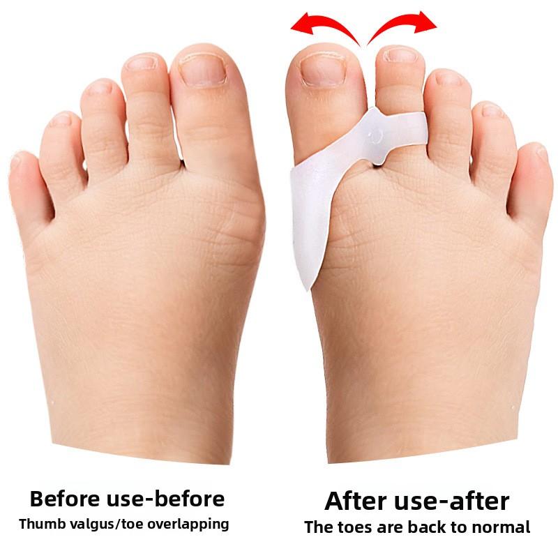 Childrens Hallux Valgus Device Big Toe Corrector for Women Adjustable Bunion Relief Double Hole Design