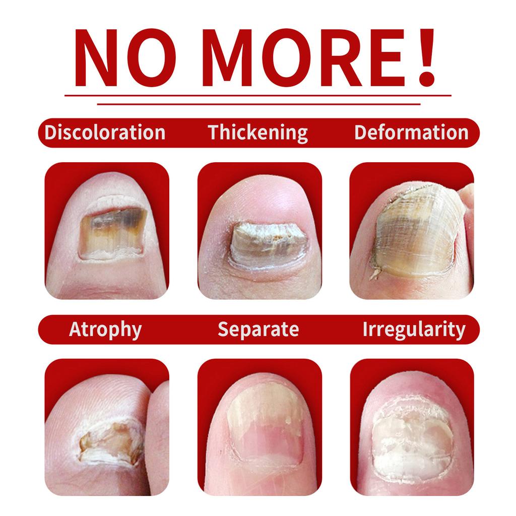 Nail Care Liquid, Soft Nail Care, Bright Nails, Onychomycosis, Hand And Foot Nail Moisturizing Liquid 30ml