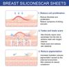 Breast Silicone Scar Sheets Repair Surgery Scar Patches