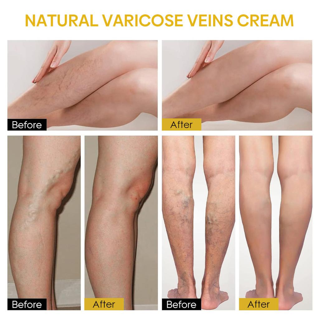 Venoheal Varicose Vein Ease Paste, Varicose Veins Paste, Varicose And Spider Veins Ease For Legs, Improve Blood Circulatio