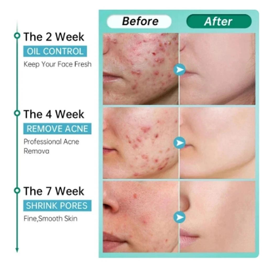 Крем от акне с салициловой кислотой для лица против черных точек, лечение акне и расширенных пор, увлажняющий крем для ухода за кожей - 50 г