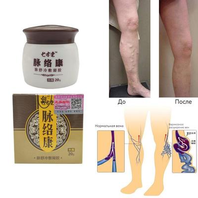 Травяная обезболивающая паста Улучшает кровообращение Паучки Для усталых тяжелых ног Быстро Эффективно