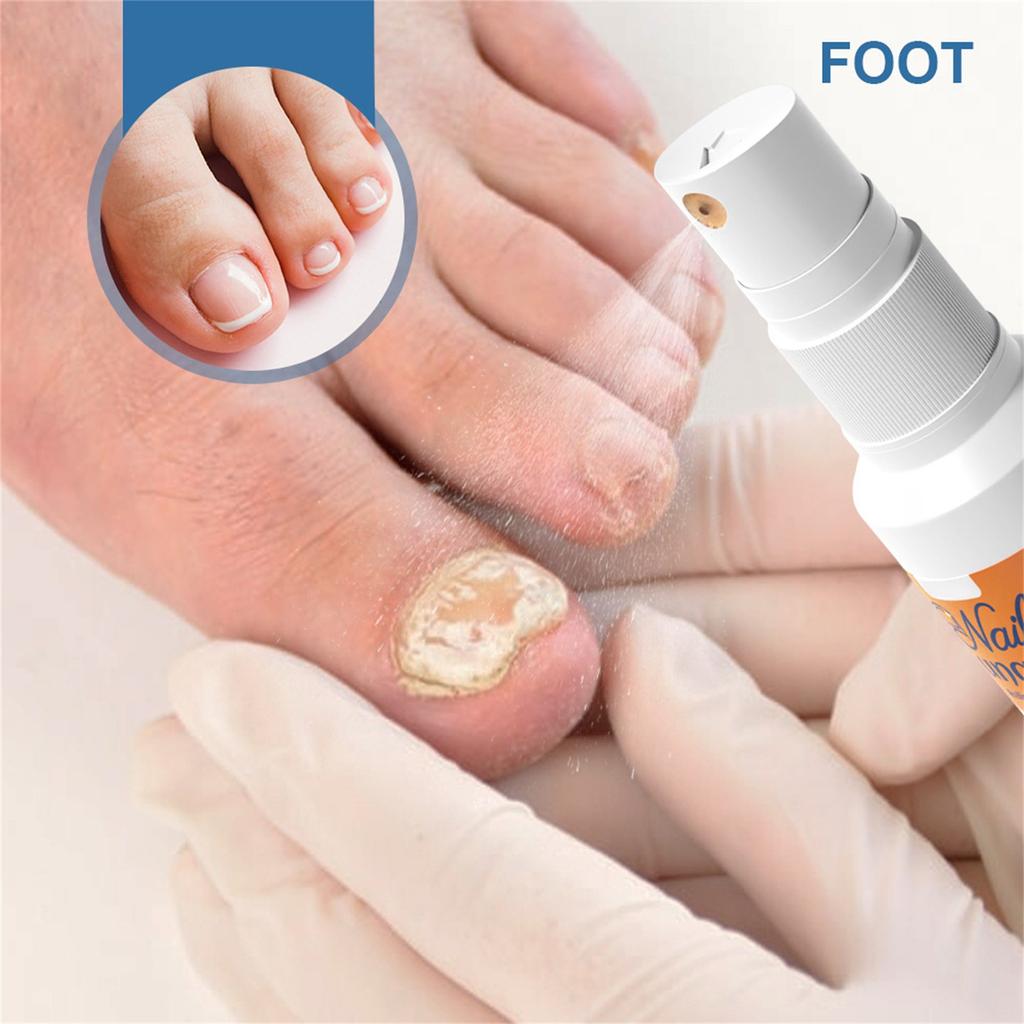 Средство от грибка ногтей на ногах, быстродействующий жидкий спрей для ухода за ногтями от грибка под ногтями и вокруг них, восстанавливает здоровый вид ногтей 30 мл