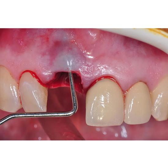 Кюретка костная GDC Hemingway №4 (CH876)