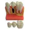 ST TS Модель зубного имплантата, Анатомическая модель зуба, Съемная, для стоматологической демонстрации