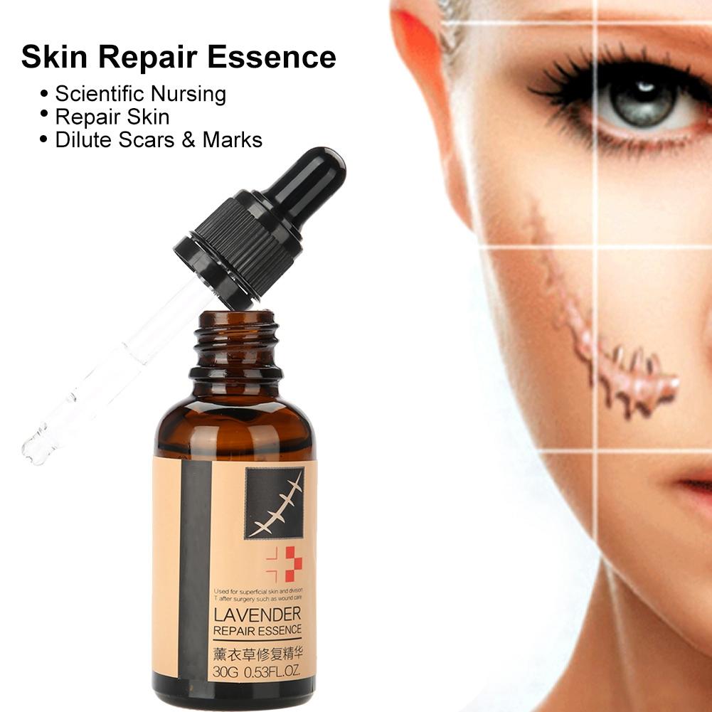 Эссенция для лечения угревой сыпи и рубцов Lavender Scar Acne Repair Essence Essence Stretch Marks Treatment Skin Repair Liquid