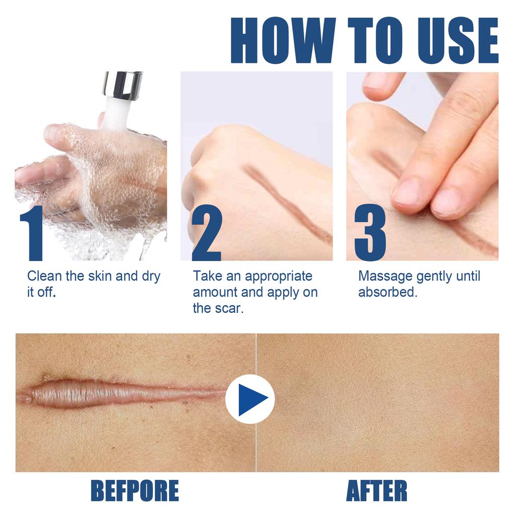 EELHOE Herbal Acne Scar Removal Cream Stretch Marks Remove Face Body Burn Surgical Scars Treatment Scar Remove Serum