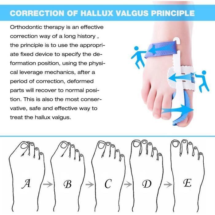 Kemei Paire de coussinets de correction avec attelle pour hallux valgus et oignon Soulagement de la douleur et correction [290]