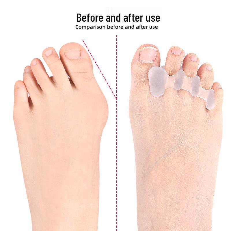Разделитель пальцев стопы при Hallux Valgus - Выравнивает перекрывающиеся пальцы, Подходит для мизинца, Можно носить с обувью с трехдырочным чехлом