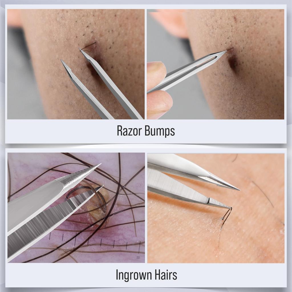 DUROX Ingrown Hair Tweezers Splint Removal Tweezers Tweezers Precision Tip Tweezers / / Fine-Tip Ultra-Fine (Pointed/Fine) Sharp-Tipped