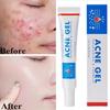 Effective Acne Removal Cream Anti-Acne Repair Redness Pimple Spots Gel Deep Cleaning Pore Oil Control Moisturizing Skin Care