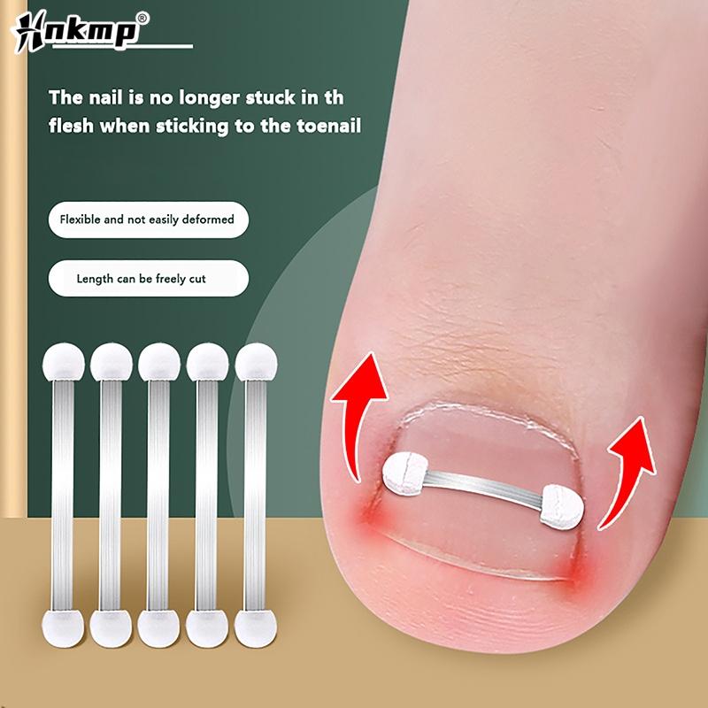 1 шт. Инструмент для коррекции вросшего ногтя, эластичная наклейка для лечения вросшего ногтя, выпрямляющий зажим, скоба, инструмент для педикюра