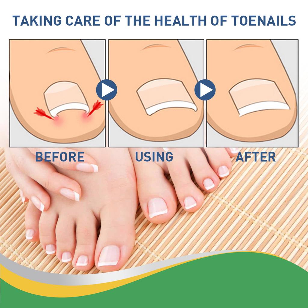 50pcs/Box Ingrown Toenail Sticker Toenail Correction Patch Tools Kit Nail Treatment Foot