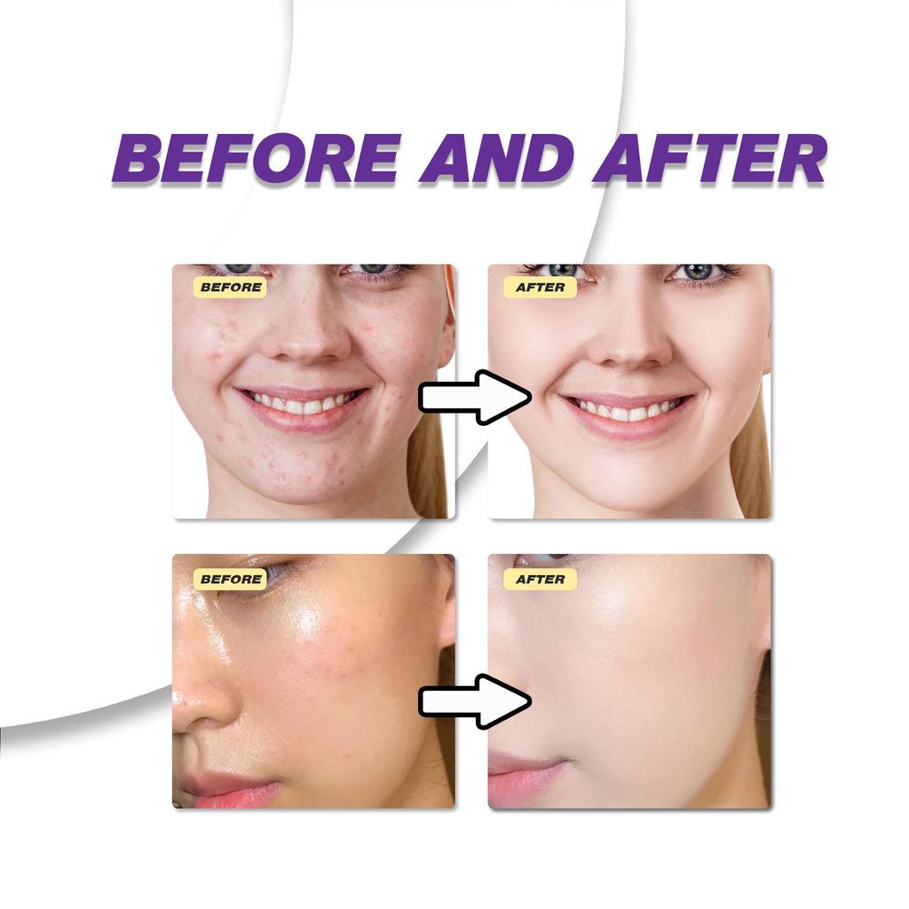 Azelaic Acid Cream – Clarifying