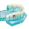 Dental Study Tooth Transparent Adult Pathological Teeth Model