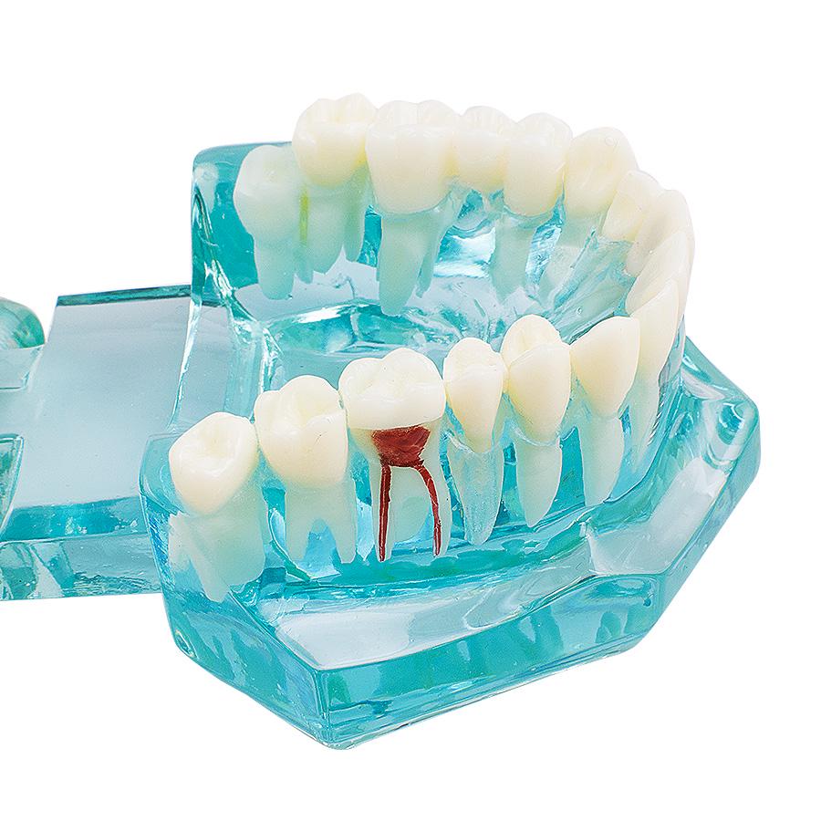 Dental Study Tooth Transparent Adult Pathological Teeth Model
