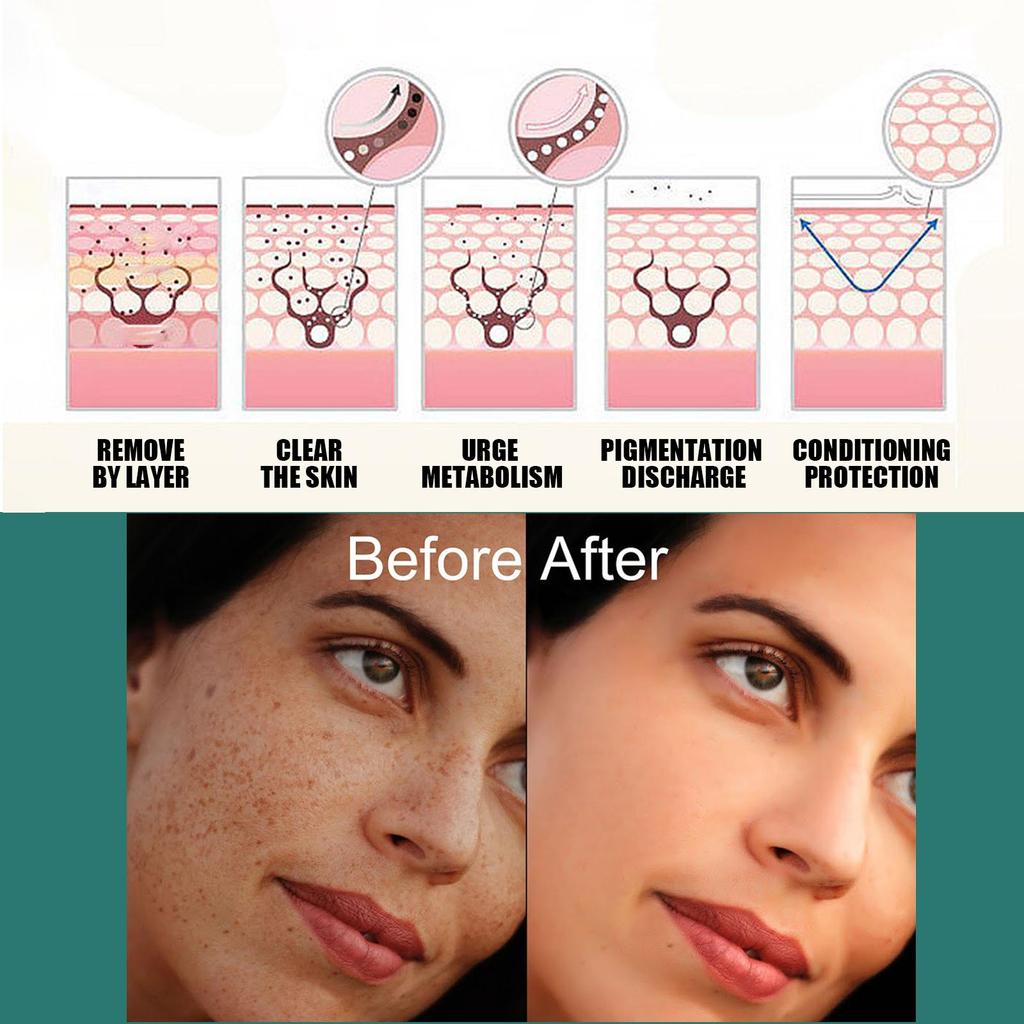 EELHOE Nicotinamide Freckles Cream Moisturizing Face Lightening Repair Skin Care Melasma Remover Pigmentation Removal Cream 30g