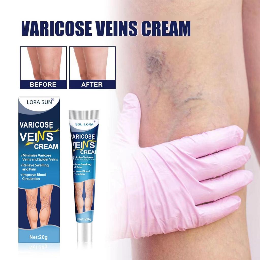 Крем SOL LORA Varicose Vein Repair Cream – снимает отеки ног и выпирающие вены
