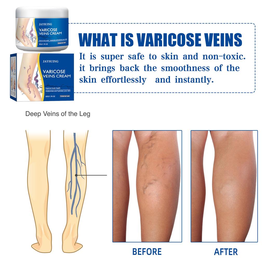High-Efficacy Leg Vein Repair Cream Varicose Massage Cream for Earthworm Leg, Activate Meridians and Alleviate Pain and Swelling