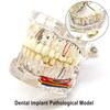 1 шт., модель зубного имплантата с нервом, патологическая модель зубного имплантата, студенты-стоматологи, коммуникационное обучение, исследования, обучение заболеваниям полости рта