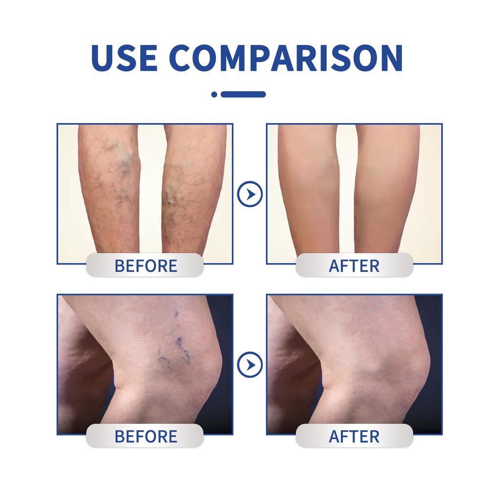 Паста Venoheal Vein Ease, паста для вен и сосудистых звездочек облегчает состояние ног, улучшает кровообращение