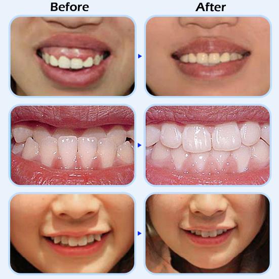 Силиконовые брекеты против храпа, 4 шт./компл., защитные брекеты для сна, предотвращающие храп, безопасные для кожи, клейкие защитные приспособления для зубов