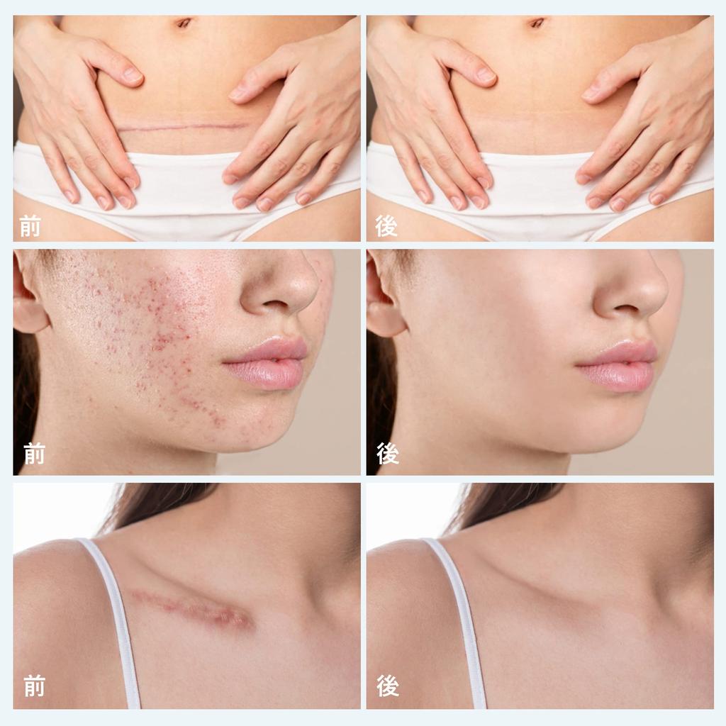 Keloid Tape Silicone Gel Sheet for Scar Care Scar Care Tape 40mm x 3000mm Post-surgery (3m)