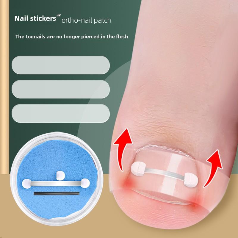 Orthopedic Nail Groove Curl Nail Lala Orthopedic Patch Toenail Long Fleshy Inlaid Nail Traction Orthopedic Button Orthosis