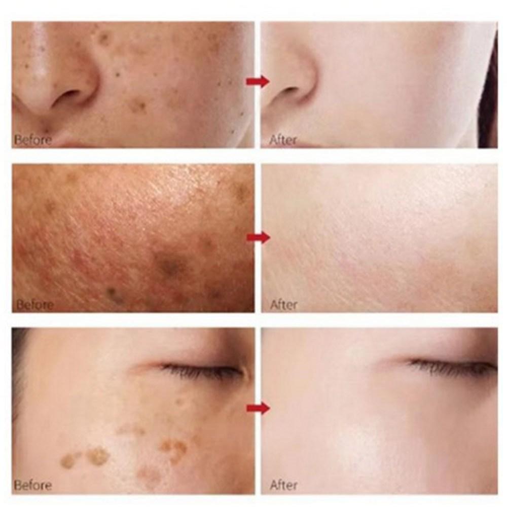 Spot Ampoule Whitening Отбеливающая эссенция Ампула Удаляет веснушки и пигментные пятна, улучшает пигментацию лица, 30 мл, 1 шт.