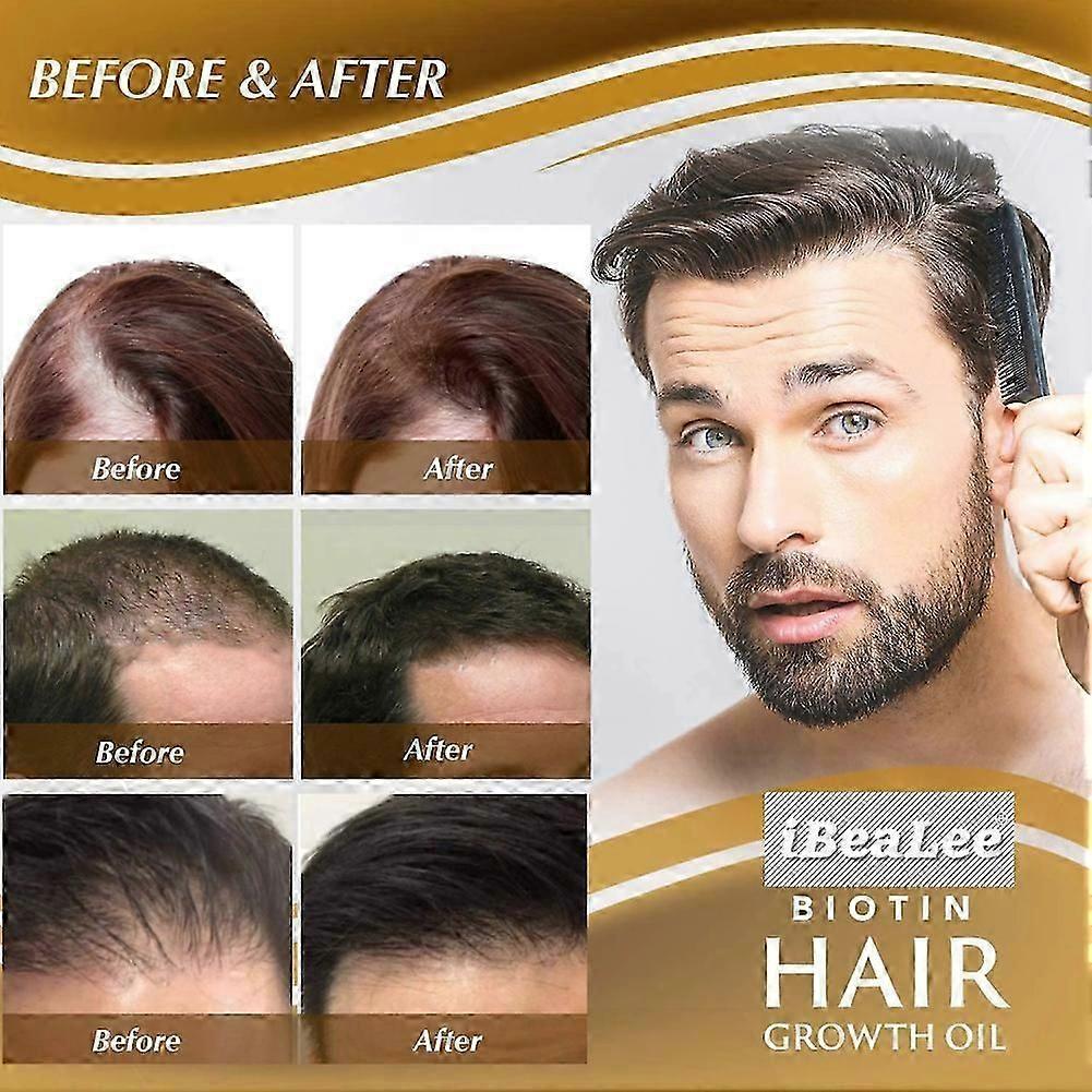 1-3x Biotin Hair Growth Spray Anti Hair Loss Fast Regrowth Scalp Treatment Serum 20ml for Men & Women
