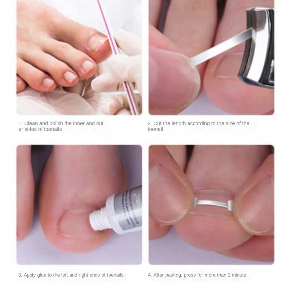 Pedicure Tool Ingrown Toenails Corrector Toenail Fixer Bunion Corrector Toenail Straightener