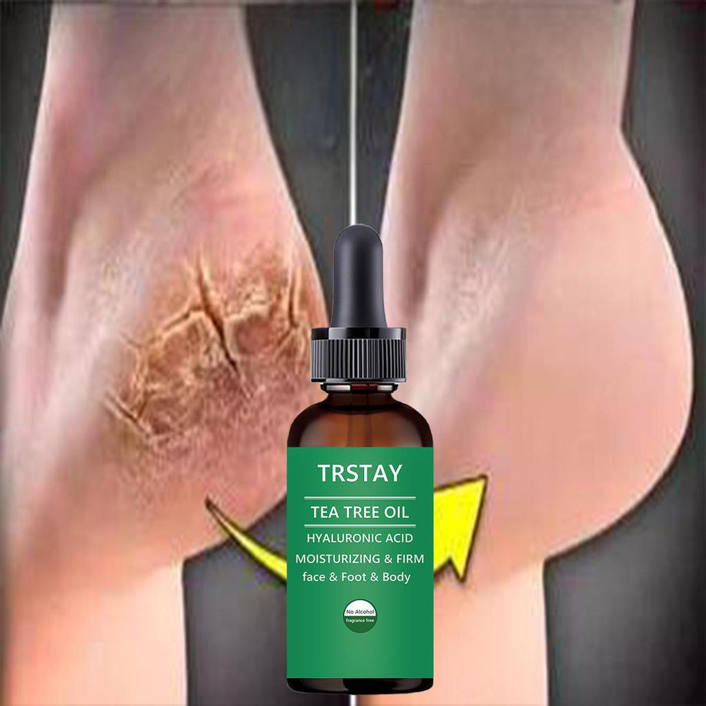 Лечение ног: Растительный лосьон для ног, увлажняющая эссенция для ухода за ногами для сухой кожи, потрескавшихся пяток, сильная целебная сила, противогрибковое средство