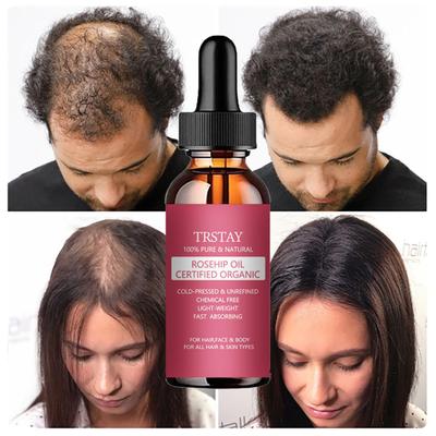 5% Миноксидил Биотин Сыворотка для волос для мужчин и женщин Густая сыворотка для волос Здоровые волосы Проникает от корней до кончиков