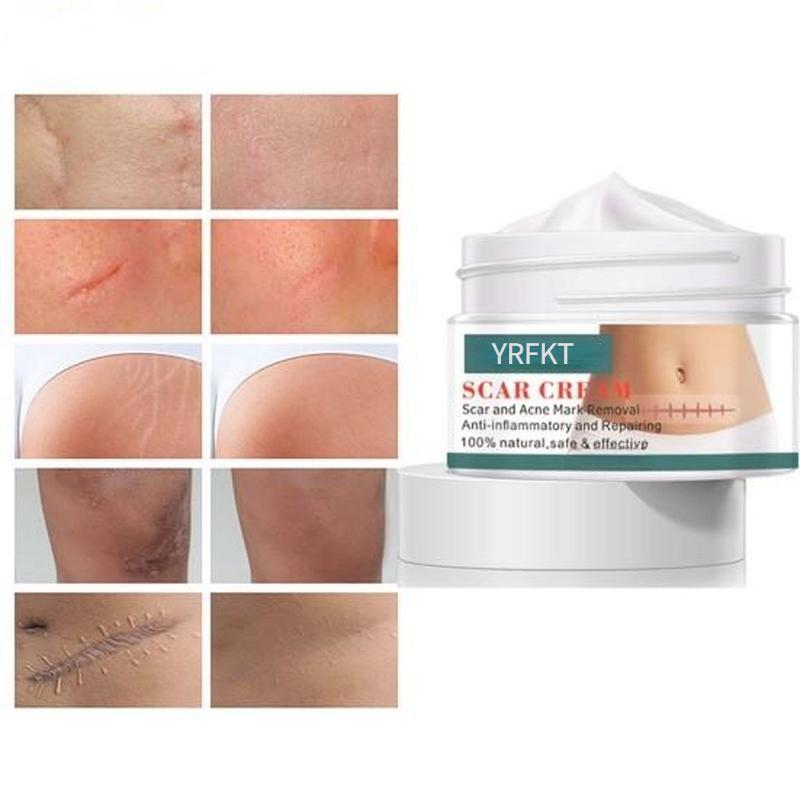 Глубоко проникающий крем для ухода за кожей кутикулы, прыщей, растяжек и шрамов