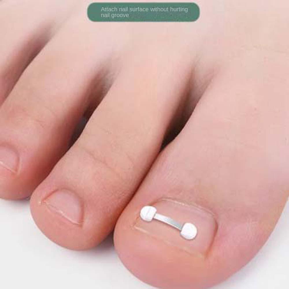 Pedicure Tool Ingrown Toenails Corrector Toenail Fixer Bunion Corrector Toenail Straightener