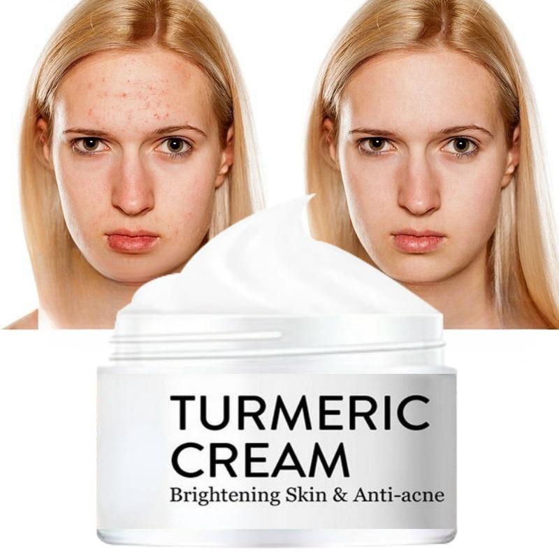 Крем для лица с травами куркумы, восстанавливающий шрам от прыщей, увлажняющий крем для темных пятен, отбеливающий, осветляющий, против прыщей, уход за кожей