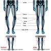 Shoes Pad Increase Height Brioche Silicone Insole Leg Varus Orthotics X/O Type Legs Correction