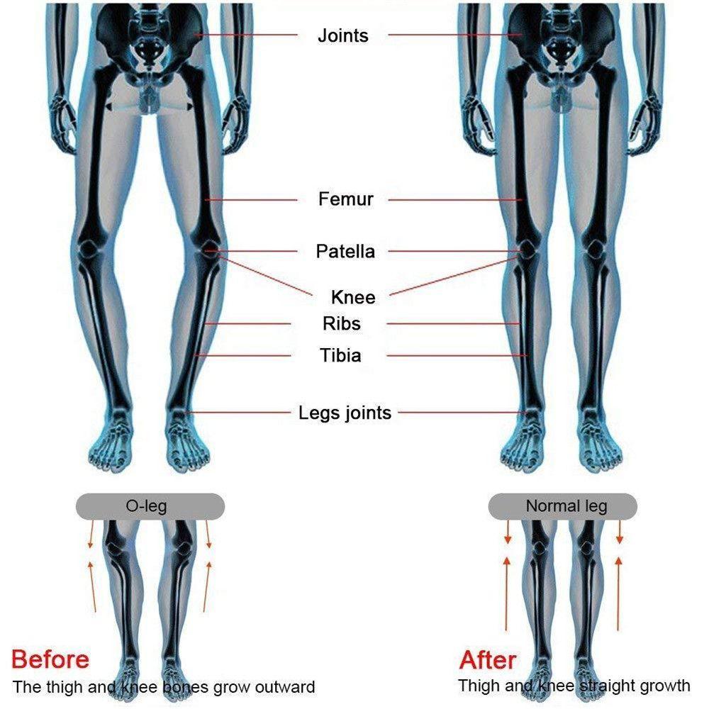 Shoes Pad Increase Height Brioche Silicone Insole Leg Varus Orthotics X/O Type Legs Correction