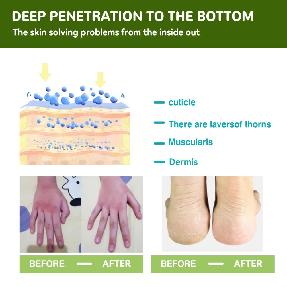 50g Urea Foot Cream Hand Anti Cracking Moisturizing Calluses Dead Skin Repair Rehydration Soften Cuticle Smooth Restore