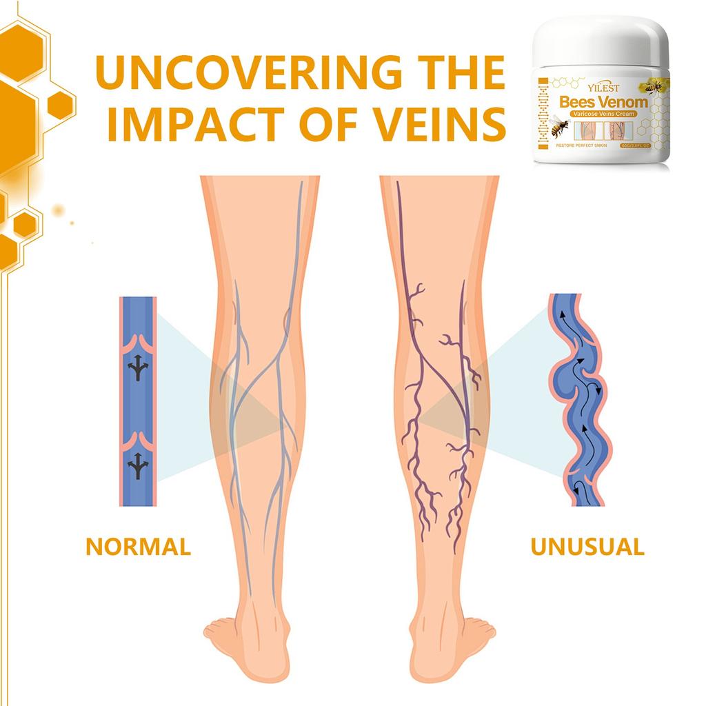 Варикозное расширение вен, сосудистые звездочки, варикозное расширение вен и сосудистых звездочек на ногах, варикозное расширение вен для ног, уход за ногами, уход за телом, 60 мл