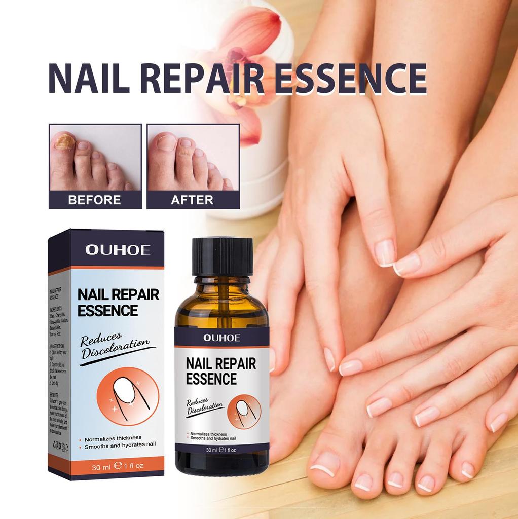 OUHOE Nail Repair Essence Soft Nail Thickening Nail Smoothing Endogenous toenail Nail Fungus Repair Essence
