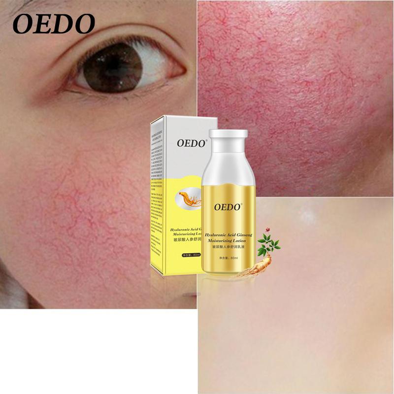 OEDO Увлажняющий лосьон с гиалуроновой кислотой и женьшенем для ухода за кожей, отбеливание, лечение акне, глубокое восстановление кожи, уход за лицом, эффект контроля жирности