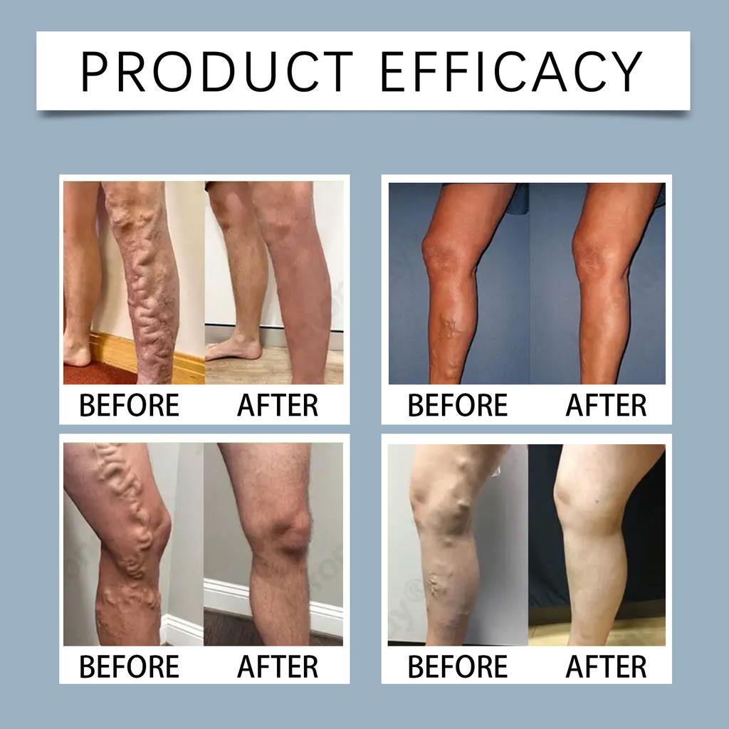 Microneedle Leg Patch; Varicose Vein Patch; Leg Patch