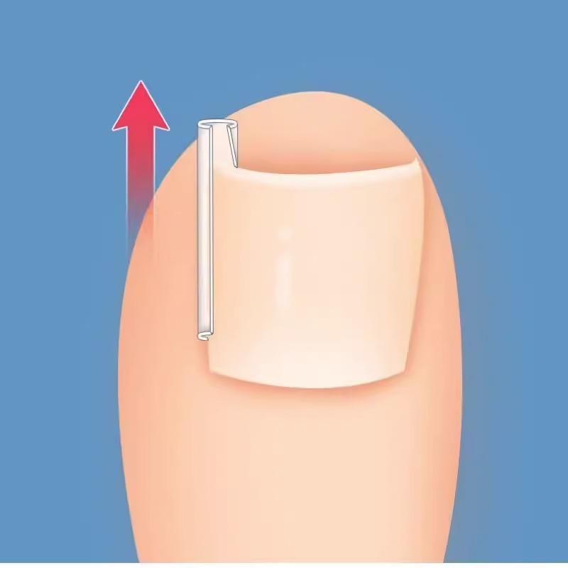 Пластыри для коррекции вросшего ногтя — пластыри для заполнения бороздок, изоляции и снятия воспаления.