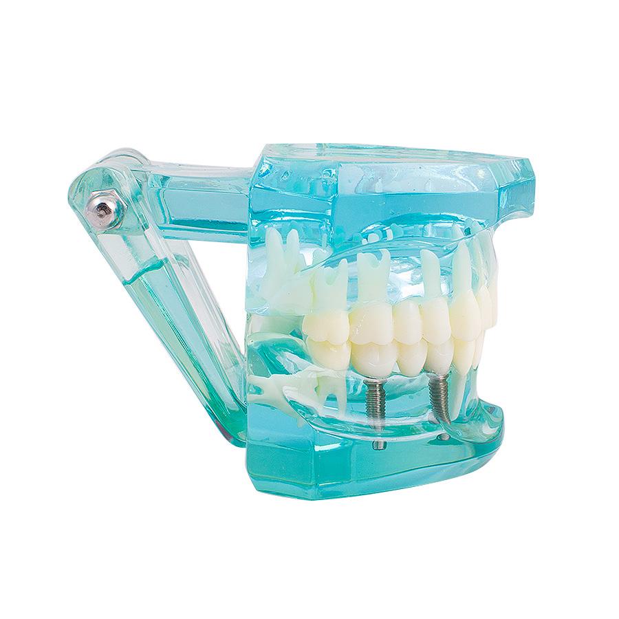 Dental Study Tooth Transparent Adult Pathological Teeth Model